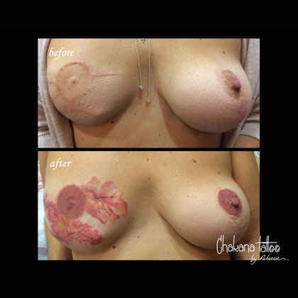 nipple-reconstruction-sq