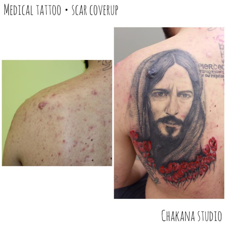 Scar Coverup Rebecca Giannopoulou Medical Tattoo